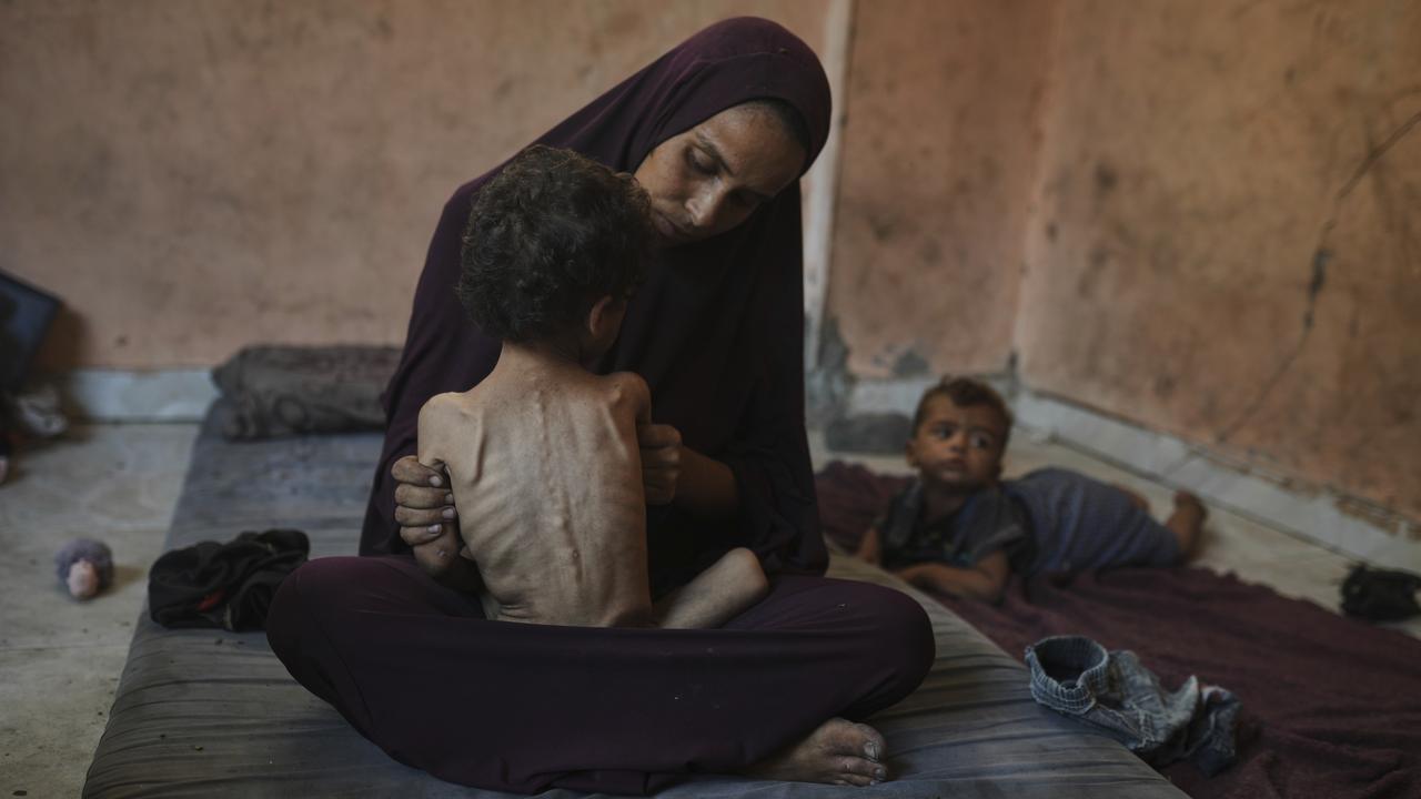Naima Abu Ful holds her malnourished 2-year-old child, Yazan